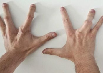 Човек се е родил с 4 пръста на всяка ръка