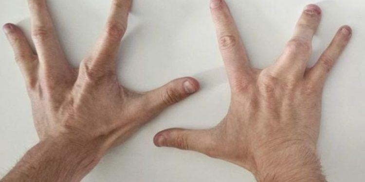 Човек се е родил с 4 пръста на всяка ръка Човек се е родил с 4 пръста на всяка ръка