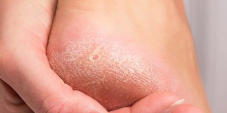 Само за период от два дни ще излекувате напуканите си пети веднъж завинаги Само за период от два дни ще излекувате напуканите си пети веднъж завинаги